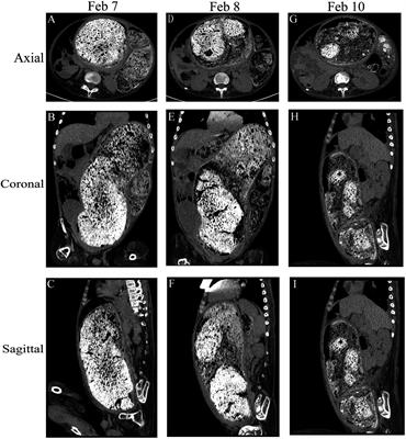 Treatment of giant fecalith colonic obstruction in a patient with Duchenne muscular dystrophy using endoscopic injection of hydrogen peroxide: a case report and literature review